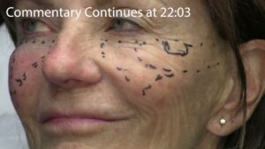 Read more about the article Tahoe 2024 Injections Video #2