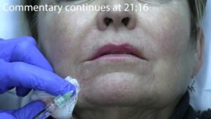 Read more about the article Tahoe 2024 Injections Video #3