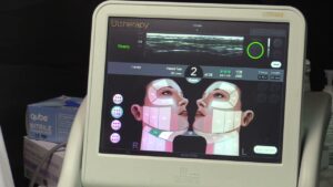 Read more about the article Ultherapy Demonstration – Corey Maas, M.D.
